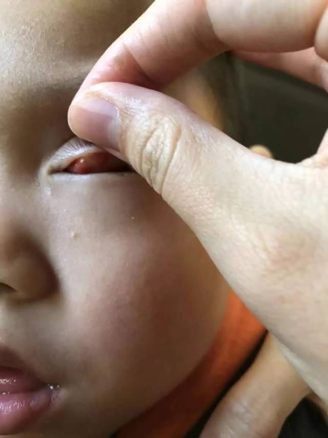 26-12.2)|麦粒肿,便秘,咳嗽,盗汗,尿床,发烧