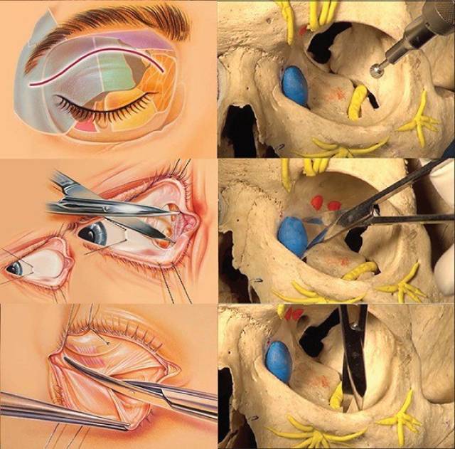 突眼手术全过程图片