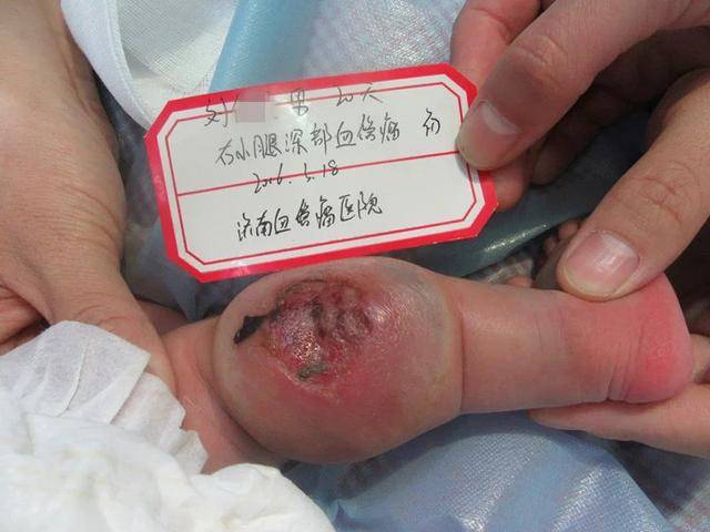 口腔,肛门生殖区域的血管瘤易形成溃疡.