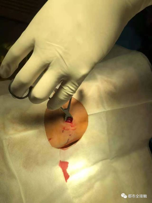 民警周阳左前臂被砍伤 伤口深达肌肉 男子夺路而逃 最终被制伏