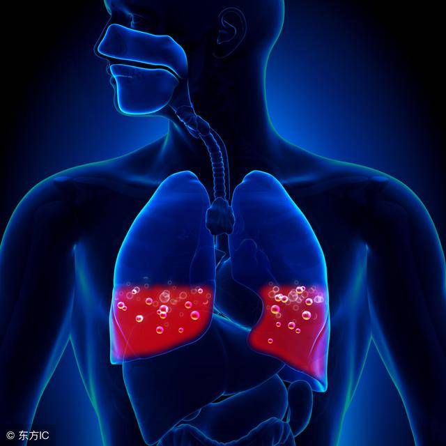 肺水肿绘图图片