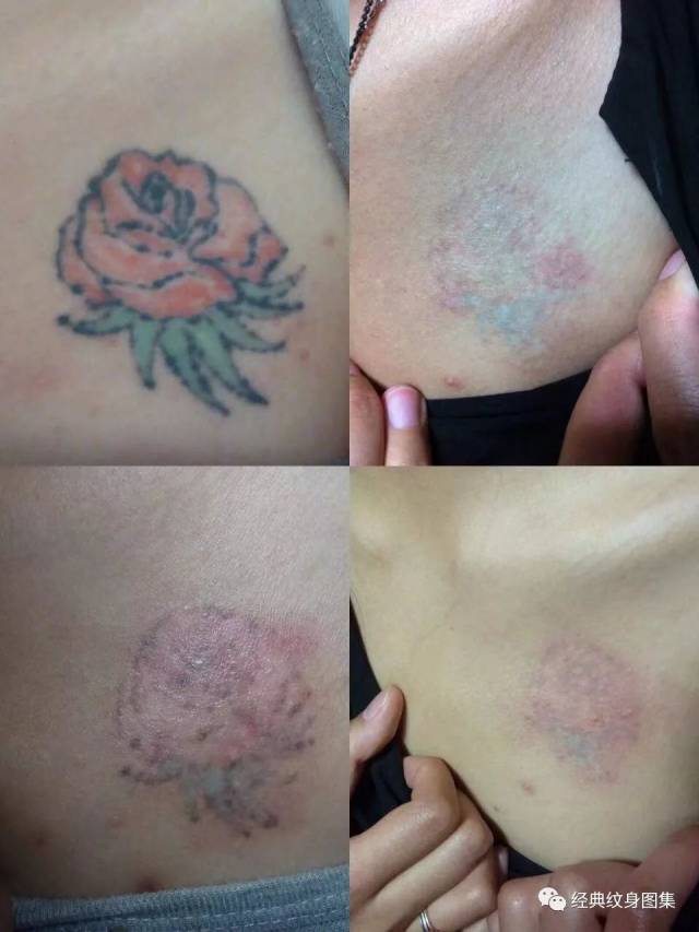 若洗纹身的人对某些食物过敏(如海鲜,辛辣等)则在治疗期间应严格忌 