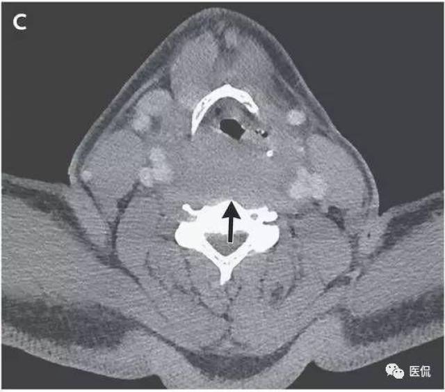 喉咽部ct图片