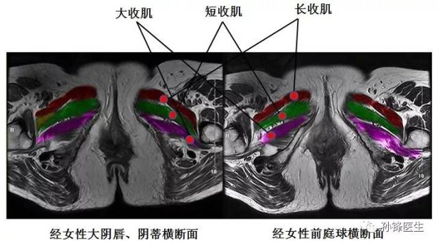 医学笔记|锋哥教你读盆腔核磁共振(2):女性经前庭球的横断面