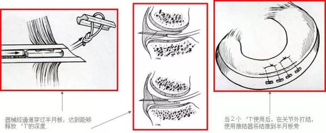 半月板縫合 (轉載)