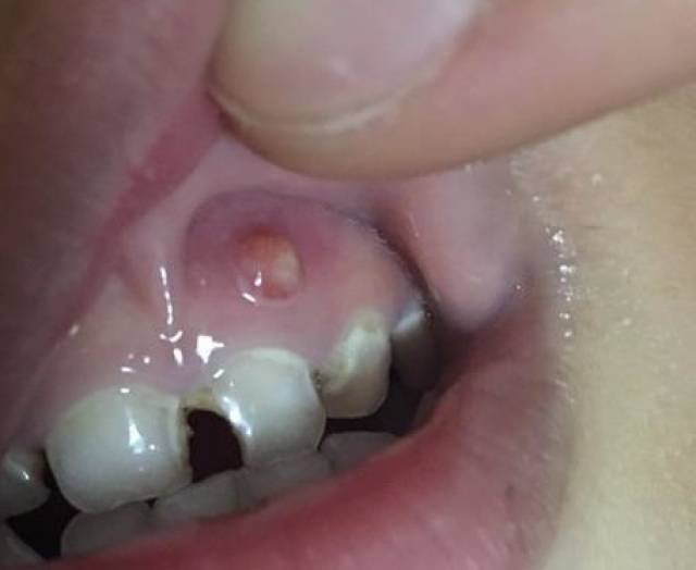 根管治疗后牙龈有一颗疙瘩怎么办