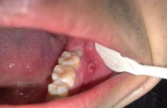 根管治疗后牙龈有一颗疙瘩怎么办