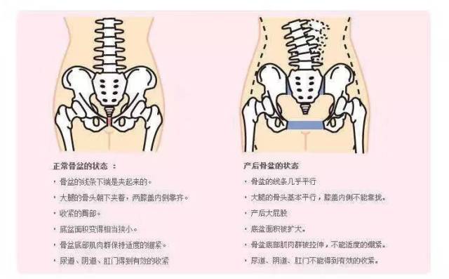 骨盆修復(產後女性)