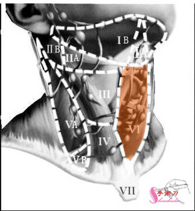 頸部淋巴結分區法示意圖