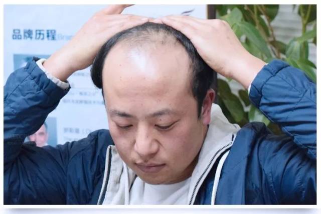 20多岁小伙遭遇秃顶危机,他用6个小时让头发重新长出来… 