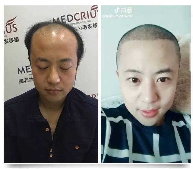 20多岁小伙遭遇秃顶危机,他用6个小时让头发重新长出来… 