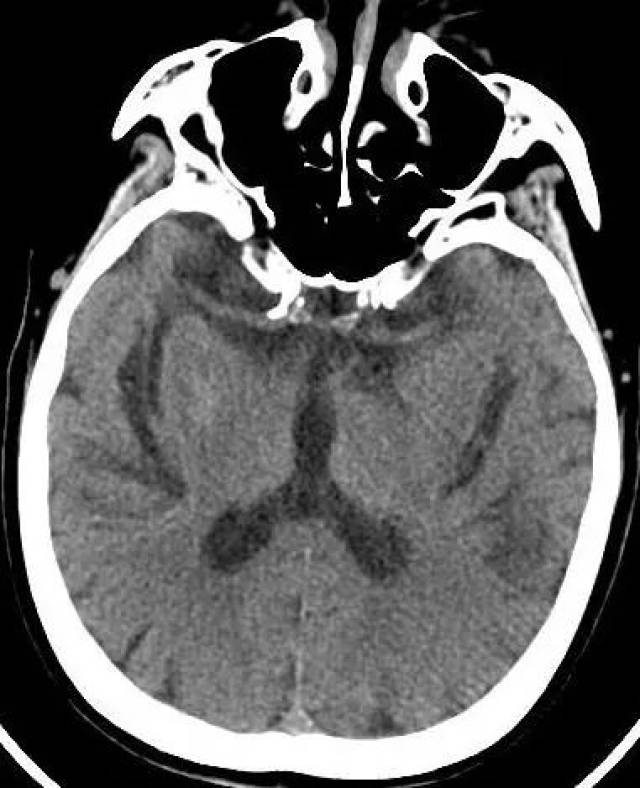 cta显示左侧大脑中动脉闭塞,但ct平扫