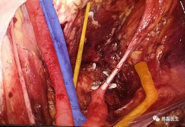 从"两面三道"浅谈侧方淋巴结清扫的技巧