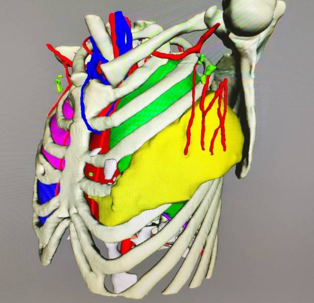 图7,三维重建图片.肿瘤范围广,向背侧延伸,肩胛骨未受侵袭.