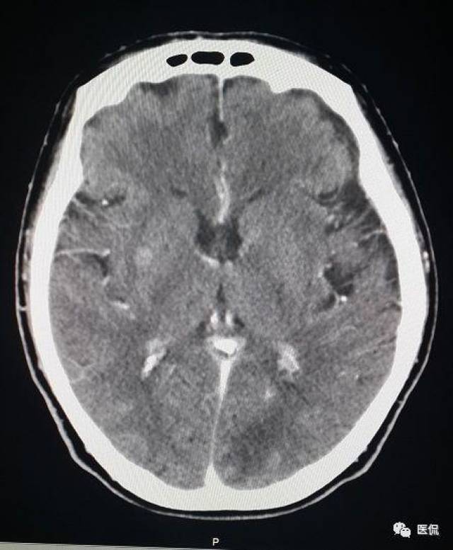 58岁阿姨头疼,脑部ct发现大小不等强化结节,怎么诊断?