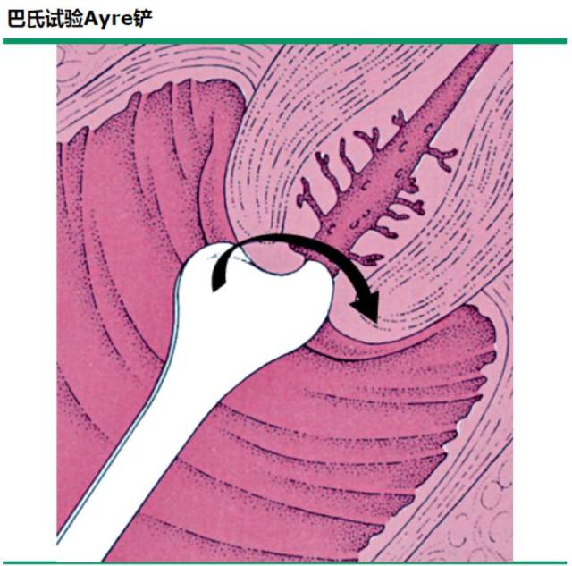 助人远离宫颈癌的"神器"—hpv检测和tct检查,该怎么做?