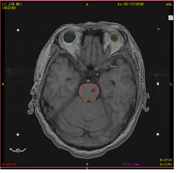 mri對腦幹內血管瘤定位圖