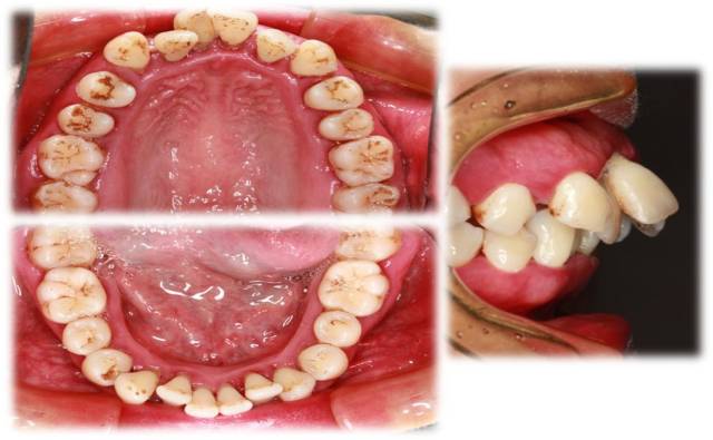 左侧上下颌术前术后对比 正畸治疗: 口内照可见前牙病理性移位,左侧