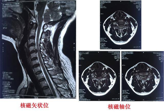 颈2背根神经节图片