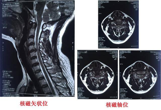 病例分享:神经根型颈椎病的手术治疗