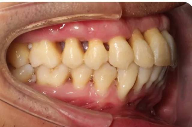 成人慢性牙周炎系统性治疗一例 | 以菌斑控制为导向的牙周治疗2018