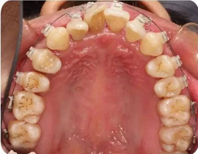 成人慢性牙周炎系统性治疗一例 | 以菌斑控制为导向的牙周治疗2018