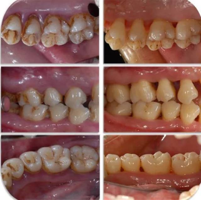 牙周炎症状图片及治疗图片