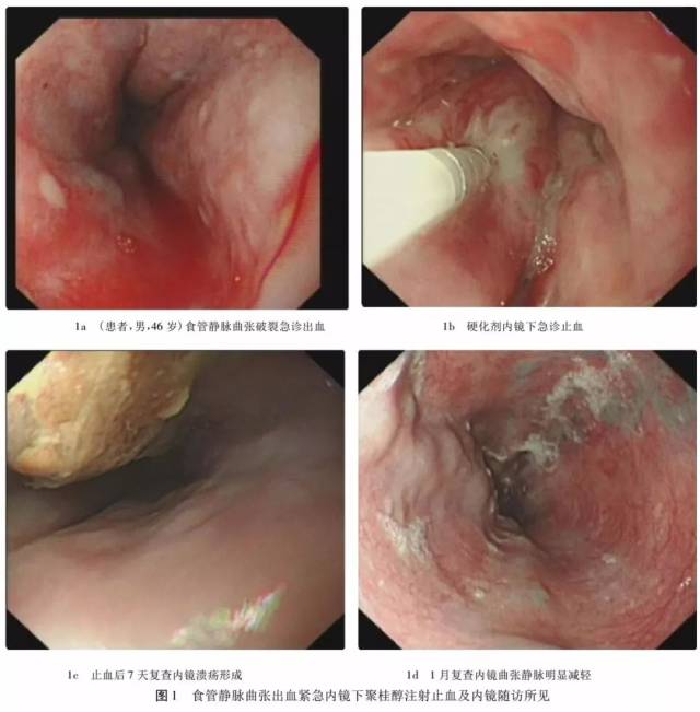 文献推荐 | 内镜下聚桂醇注射治疗食管静脉曲张的临床应用分析