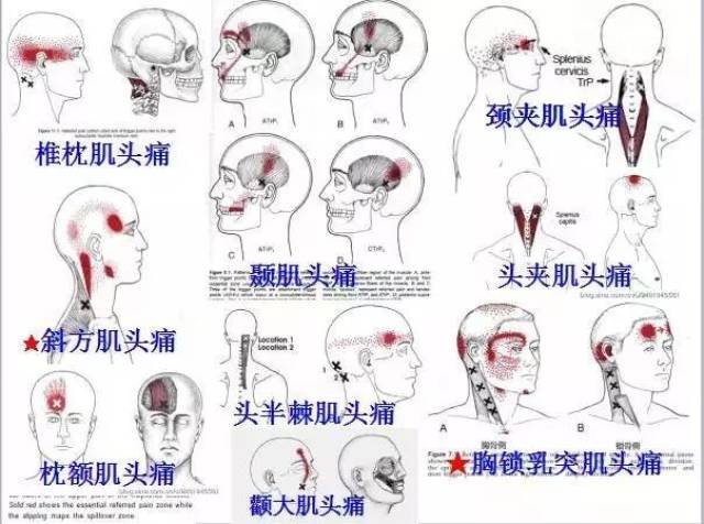 【疼痛康复必备】《全身激痛点手册》肌筋膜疼痛与功能障碍图文全解