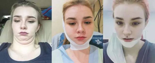 最近被疯转的女孩jessie vard,公开整容过程!