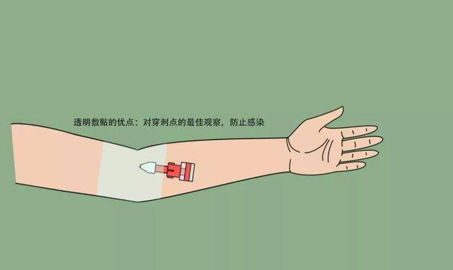 操作流程丨透析用留置针在血液净化中的标准化使用流程