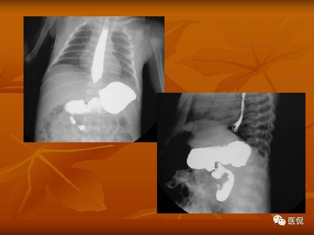 胃扭转的x线诊断与鉴别诊断 医学影像经典ppt