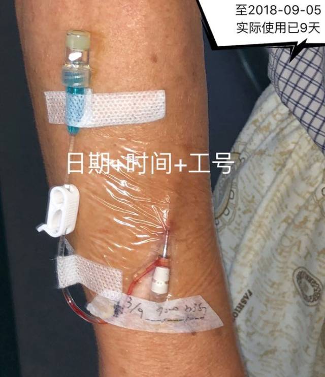 留置針固定的這個細節,你確定做規範了嗎?