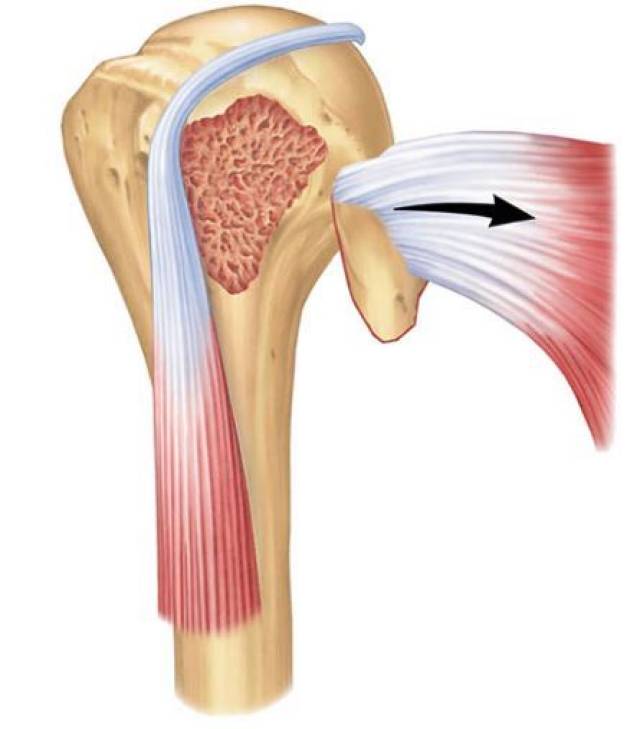 第v种类型:肱骨小结节移位骨折