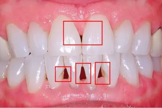 牙齿上难看的黑三角是怎样形成的?