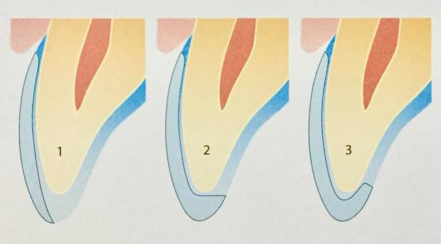 开窗型,对接型,包绕型, 该案例方案最终选择开窗型贴面修复 定深沟