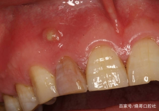 如何区分普通牙齿发炎和智齿发炎?