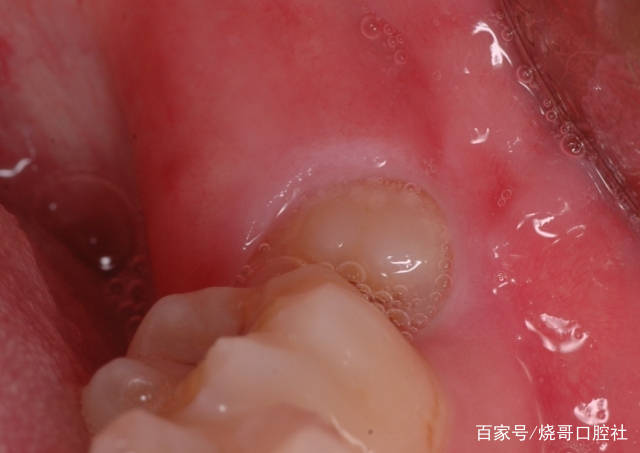 如何区分普通牙齿发炎和智齿发炎