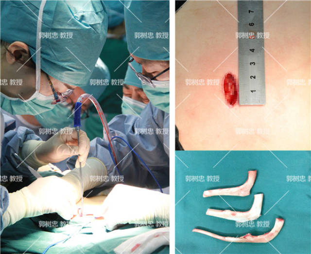 小耳症那些事儿四十五为什么要用开膛剖腹这个词