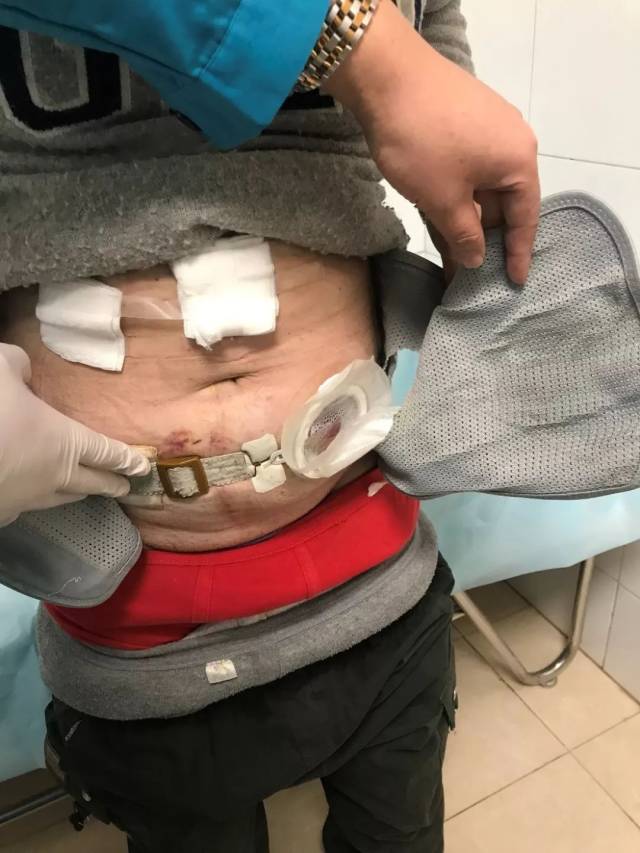 专家救治造口旁鼓个包专家说那是疝得治