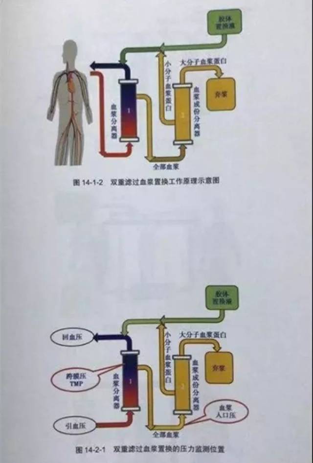 人工肝血浆置换术图片