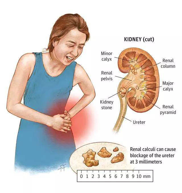 9岁男孩爱吃肉不爱喝水,肾里长出56颗结石,肾结石应该怎么吃?