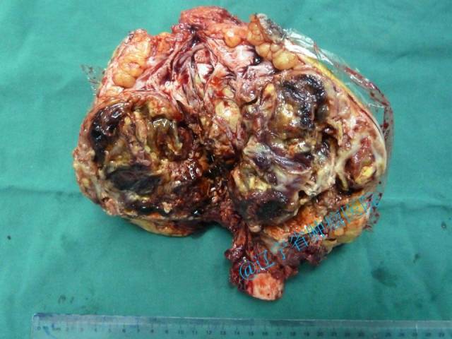 股骨远端复发骨巨细胞瘤手术治疗---假体置换 肌皮瓣修复 (原创)