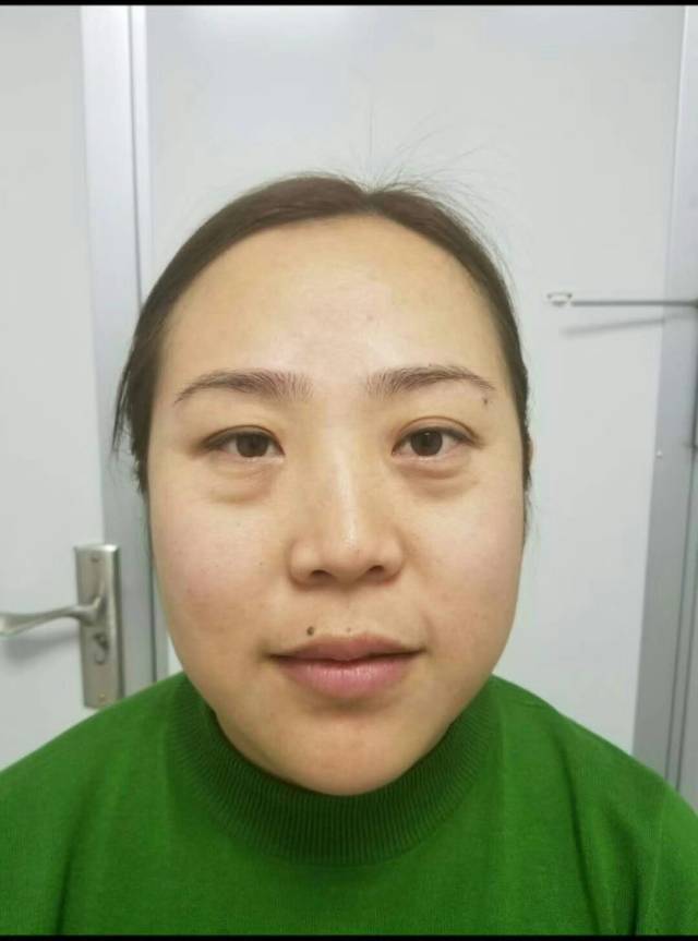 戴眼镜是否会使眼袋加重原悦告诉你眼袋加重有什么影响