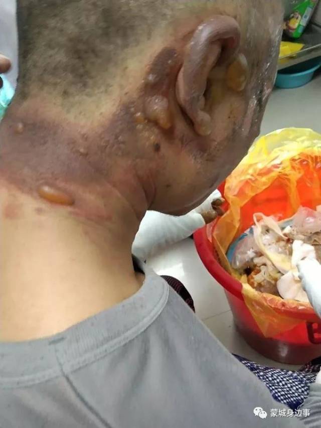 安徽蒙城一居民家中发生燃气爆炸,一居民身上多处被烧伤