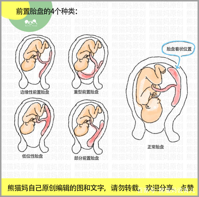 刨腹产前置胎盘怎么取出来 前置胎盘抛妇产危险吗