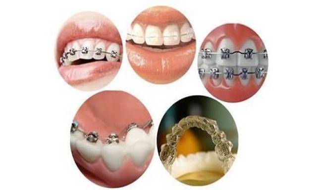牙齿矫正器类型图片