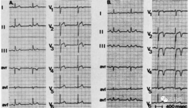 综合征:是什么\/为什么\/怎么办? 细说心电图