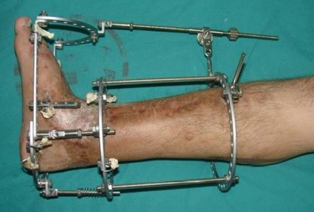 安装外固定支架,微创方法延长跟腱