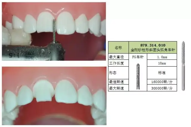 【牙体预备】标准化预备/车针使用技巧